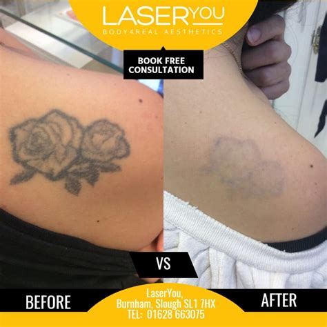 picosure tattoo removal reviews